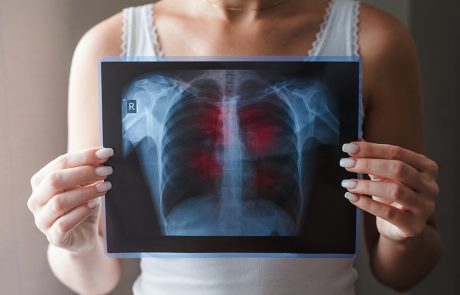 מה גורם לסרטן הריאה?